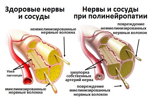 Диабетическая полинейропатия