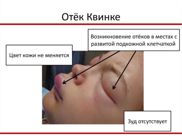 Особенности отека Квинке