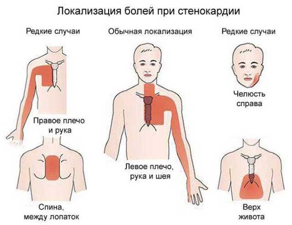 Боли при стенокардии