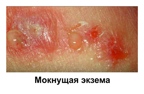 Мокнущая экзема