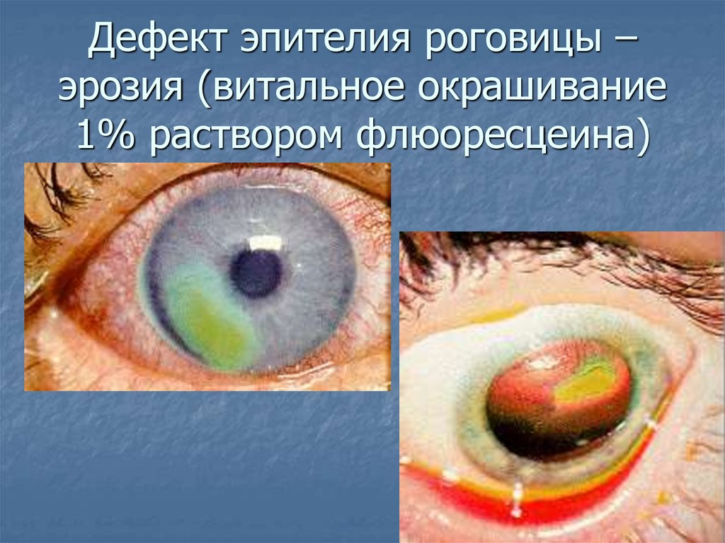 Эрозия роговицы