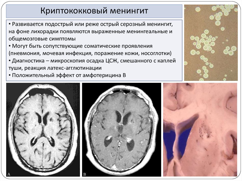 Криптококковый менингит