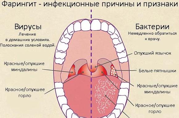 Фарингит