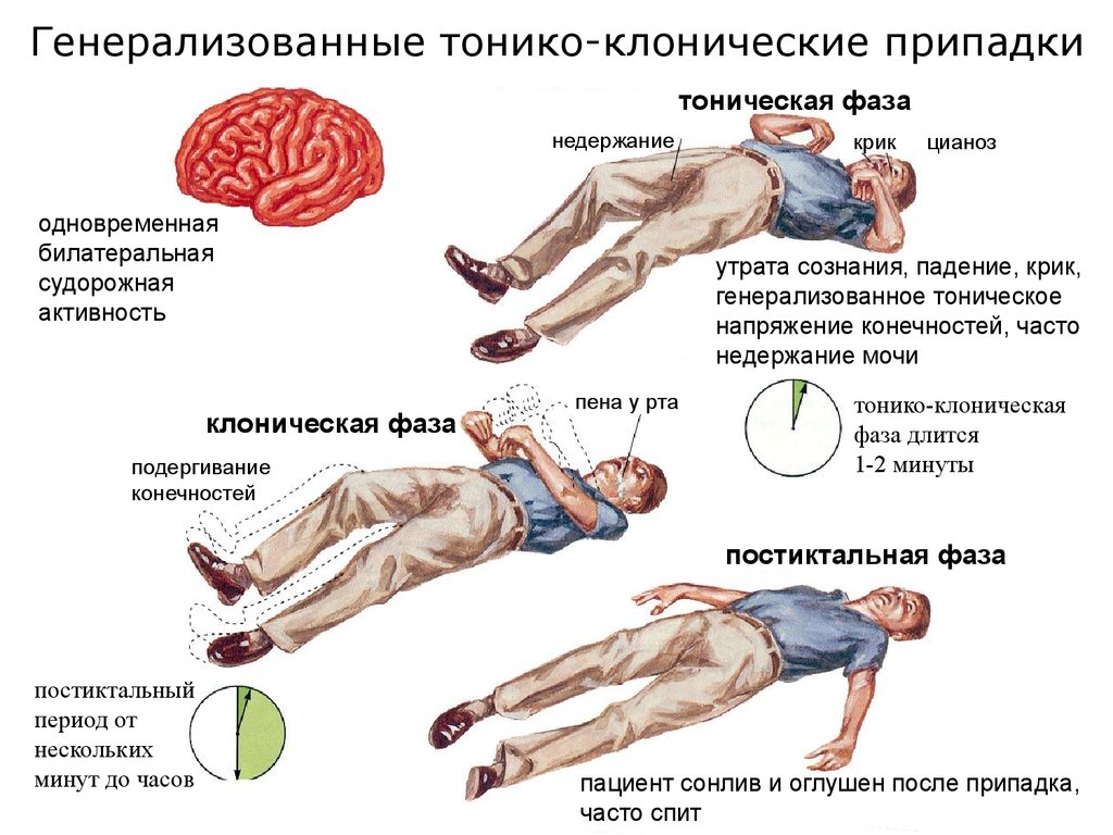 Клонические судороги