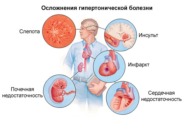 Осложнения гипертонии