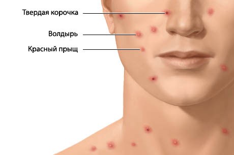 Ветрянка 