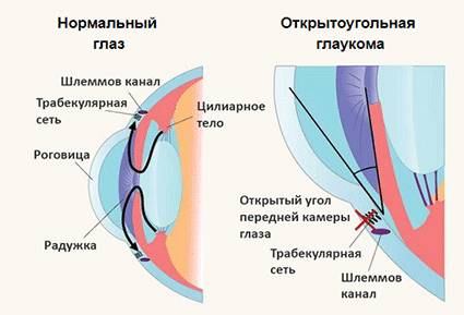 Открытоугольная глаукома
