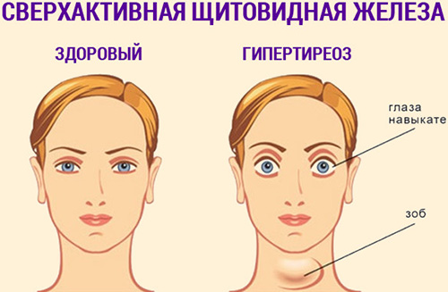 Гипертиреоз