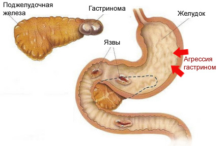 Синдром Золлингера-Эллисона