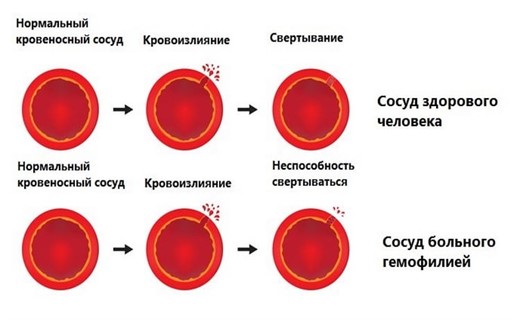 Гемофилия
