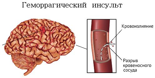 Геморрагический инсульт