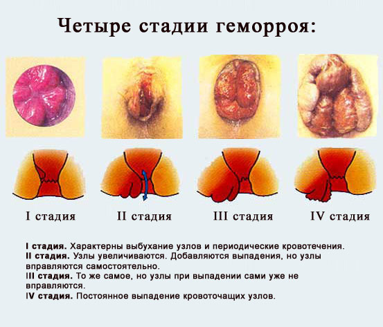 Стадии геморроя