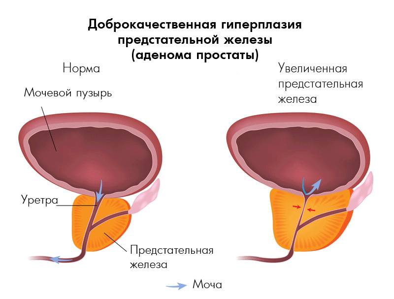 Гиперплазия аденомы простаты