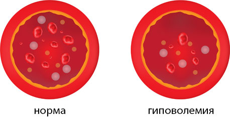 Гиповолемия