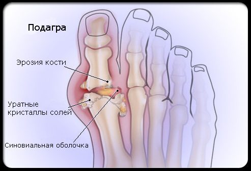 Подагра