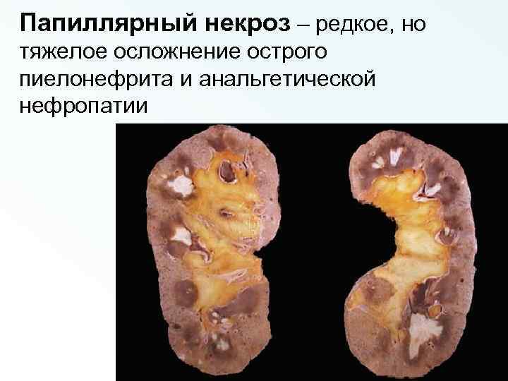 Папиллярный некроз