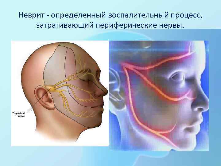 Неврит