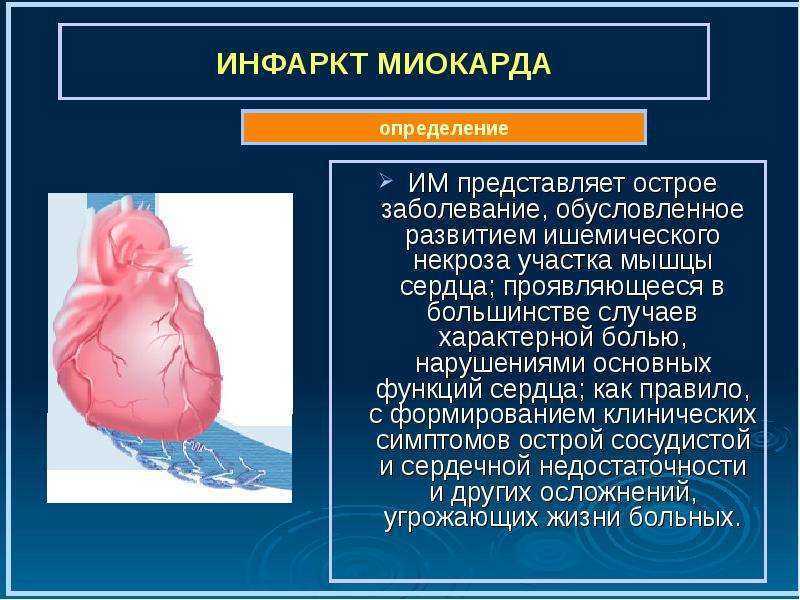 Инфаркт миокарда