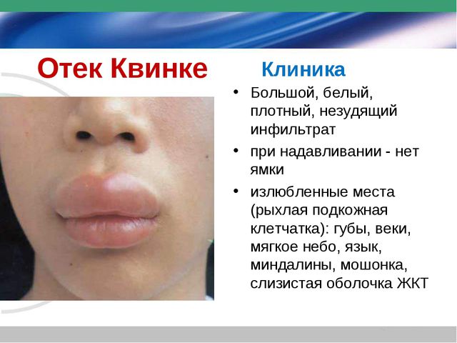 Отек Квинке