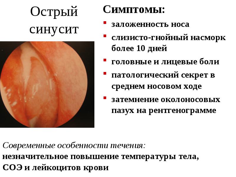 Синусит