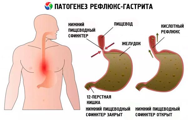Рефлюкс-гастрит