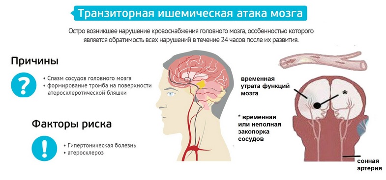 Ишемическая атака