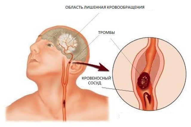 Ишемия головного мозга