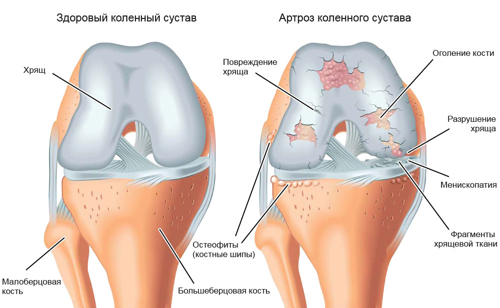 Артроз коленного сустава