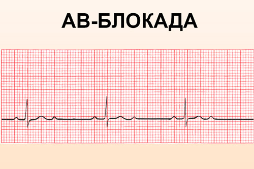 АВ-блокада