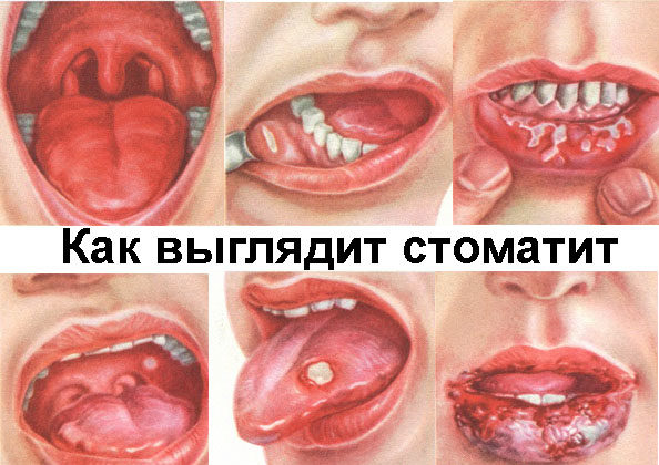 Стоматит