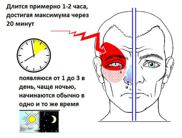 Особенности кластерной головной боли