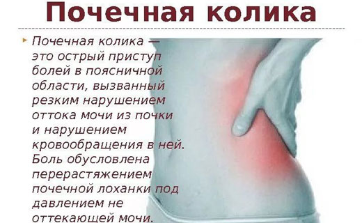 Определение почечной колики