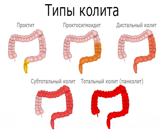 Виды колита