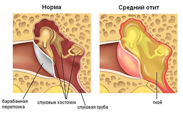 Отит