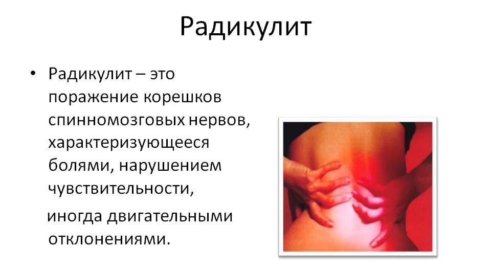 Радикулит