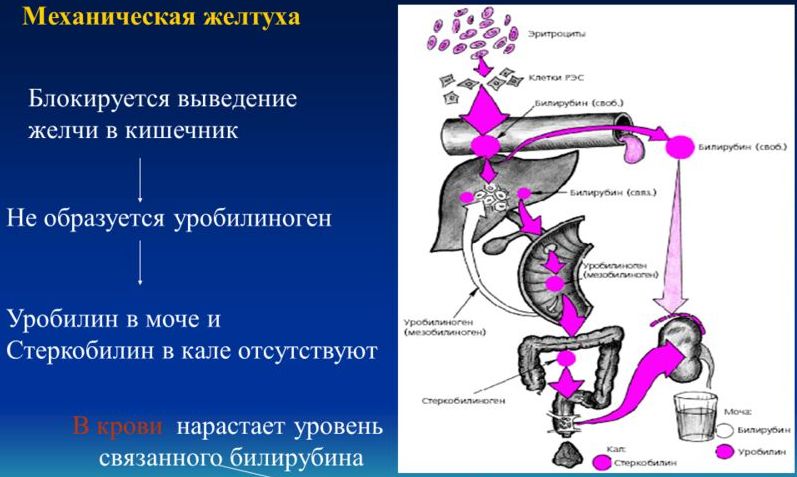 Механическая желтуха 