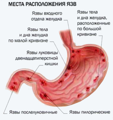 Язвенная болезнь 