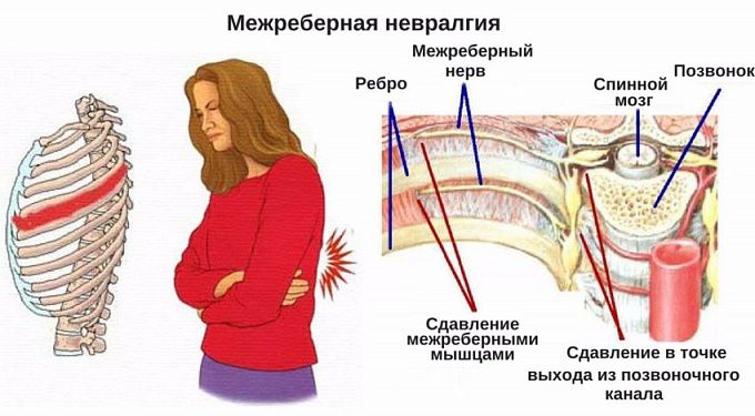 Невралгия