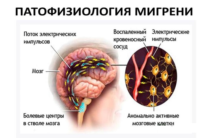 Процесс развития мигрени
