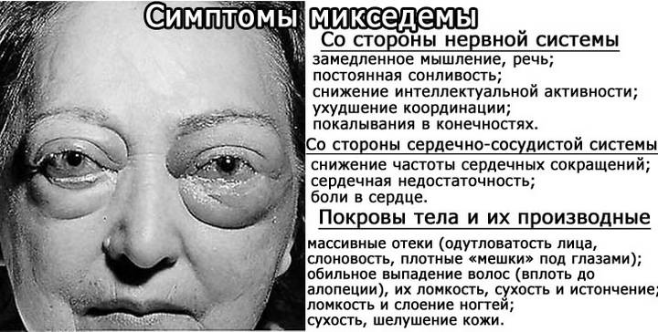 Проявления микседемы