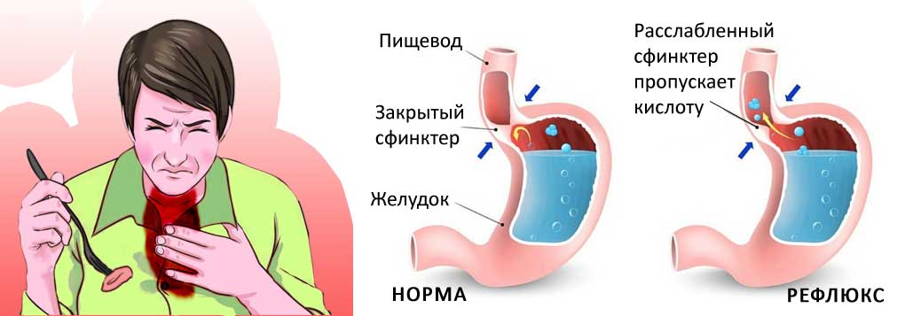 Изжога