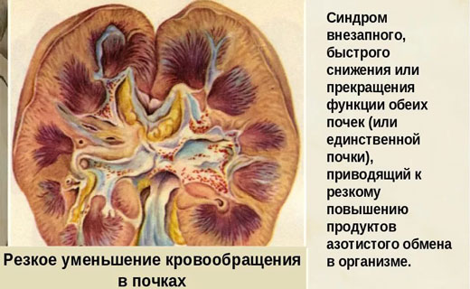 Почечная недостаточность
