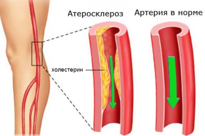 Атеросклероз