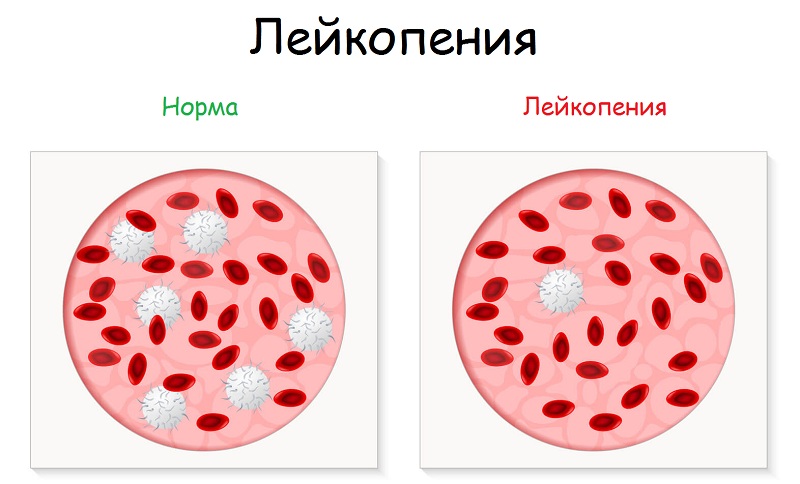 Лейкопения