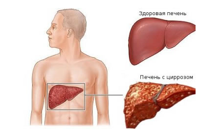Цирроз печени