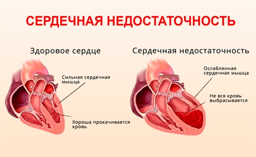 Сердечная недостаточность