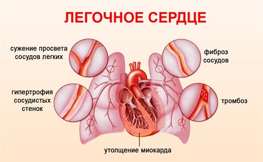 Легочное сердце