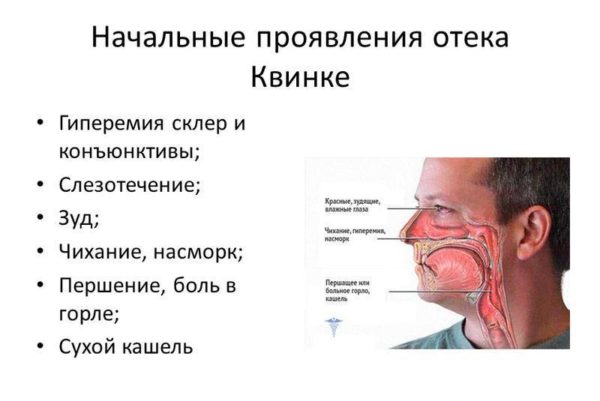 Отек Квинке