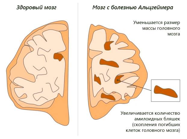 Болезнь Альцгеймера