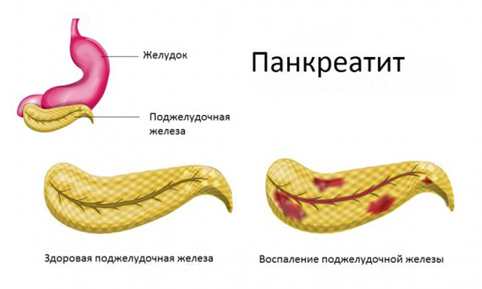 Панкреатит